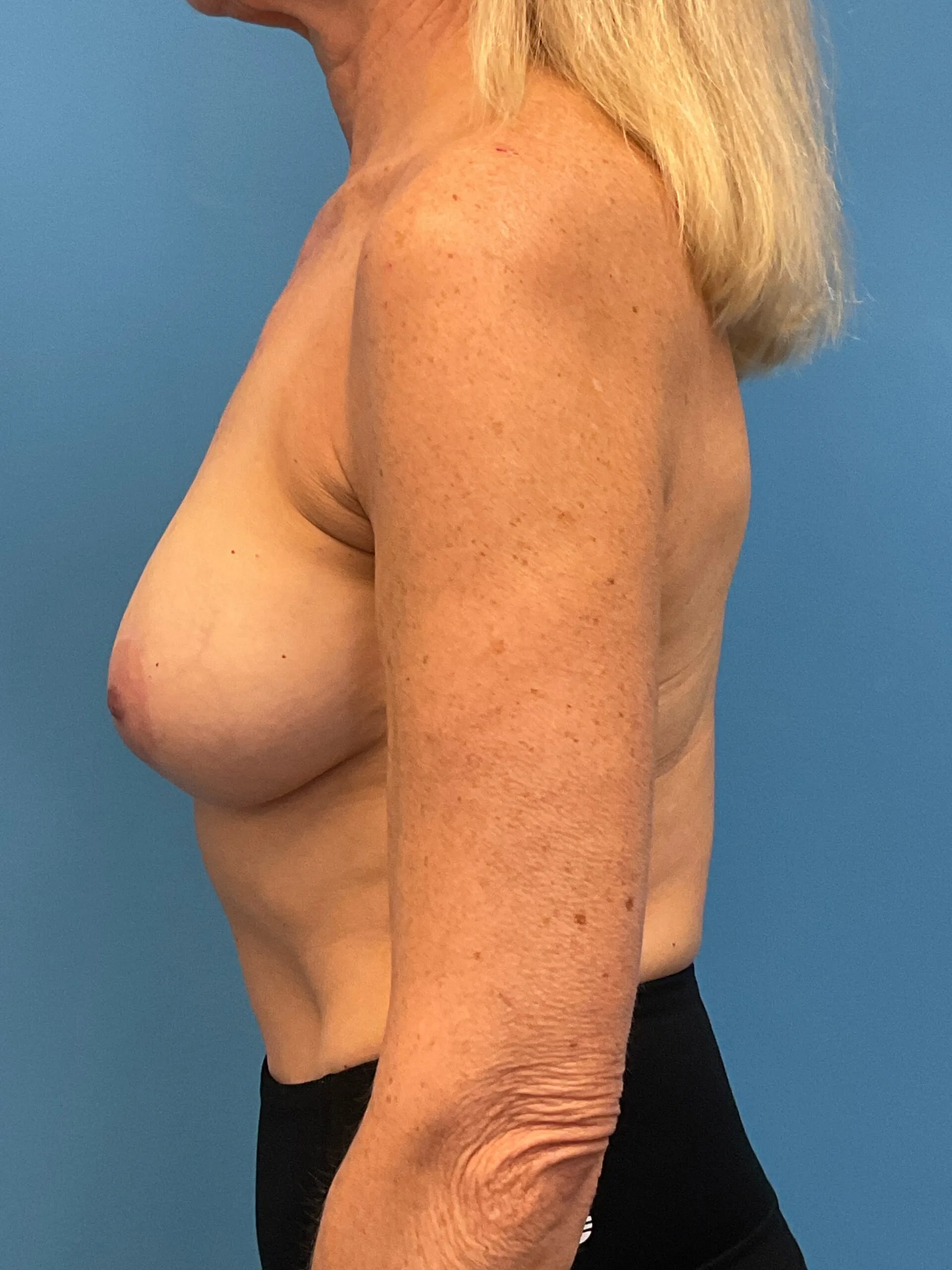 Revision-Breast-Augmentation-Case--9027 | Before Revision Augmentation 3