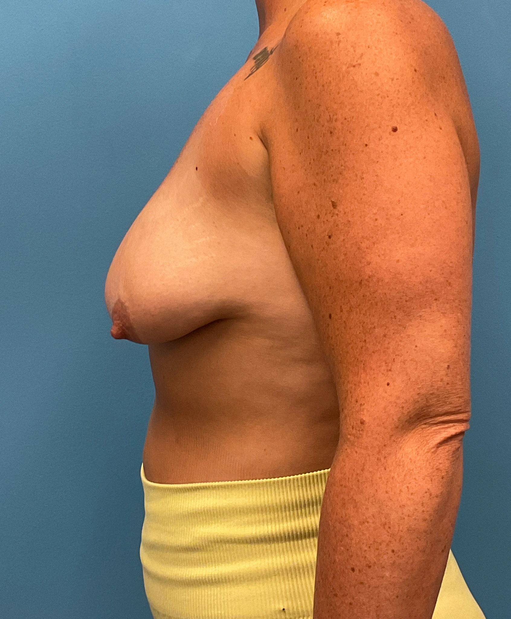 Augmentation-Mastopexy-Case--6658 | Before Breast Augmentation With Lift 3
