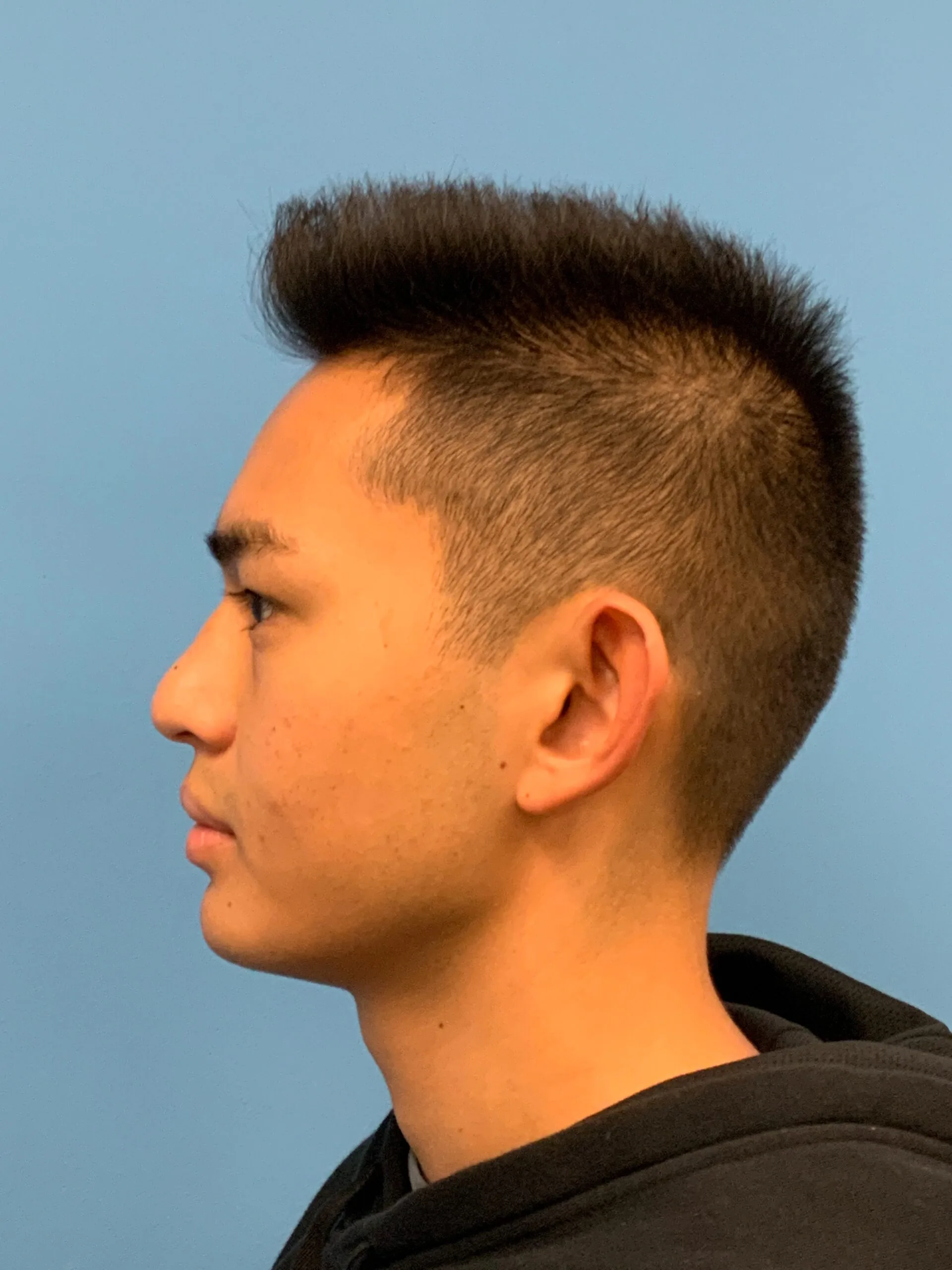 Otoplasty-Case--2681 | Before Otoplasty 2