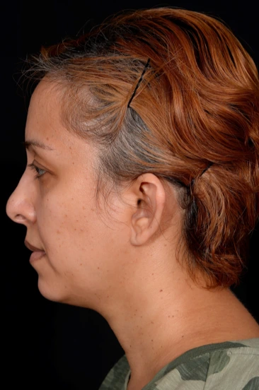 Otoplasty-Case--4655 | Before Otoplasty 3