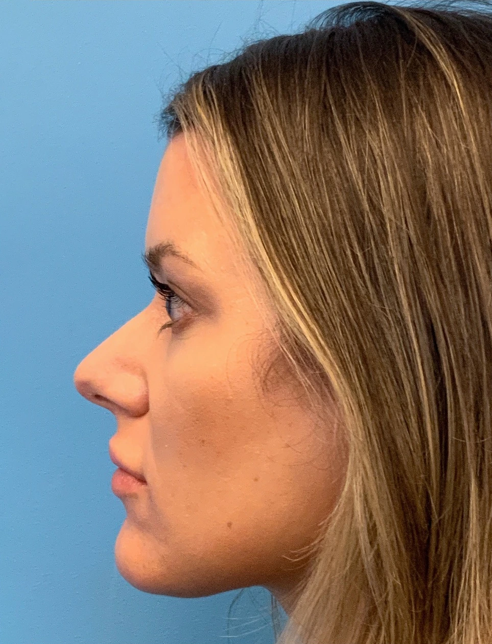 Rhinoplasty-Case--4972 | Before Rhinoplasty 4