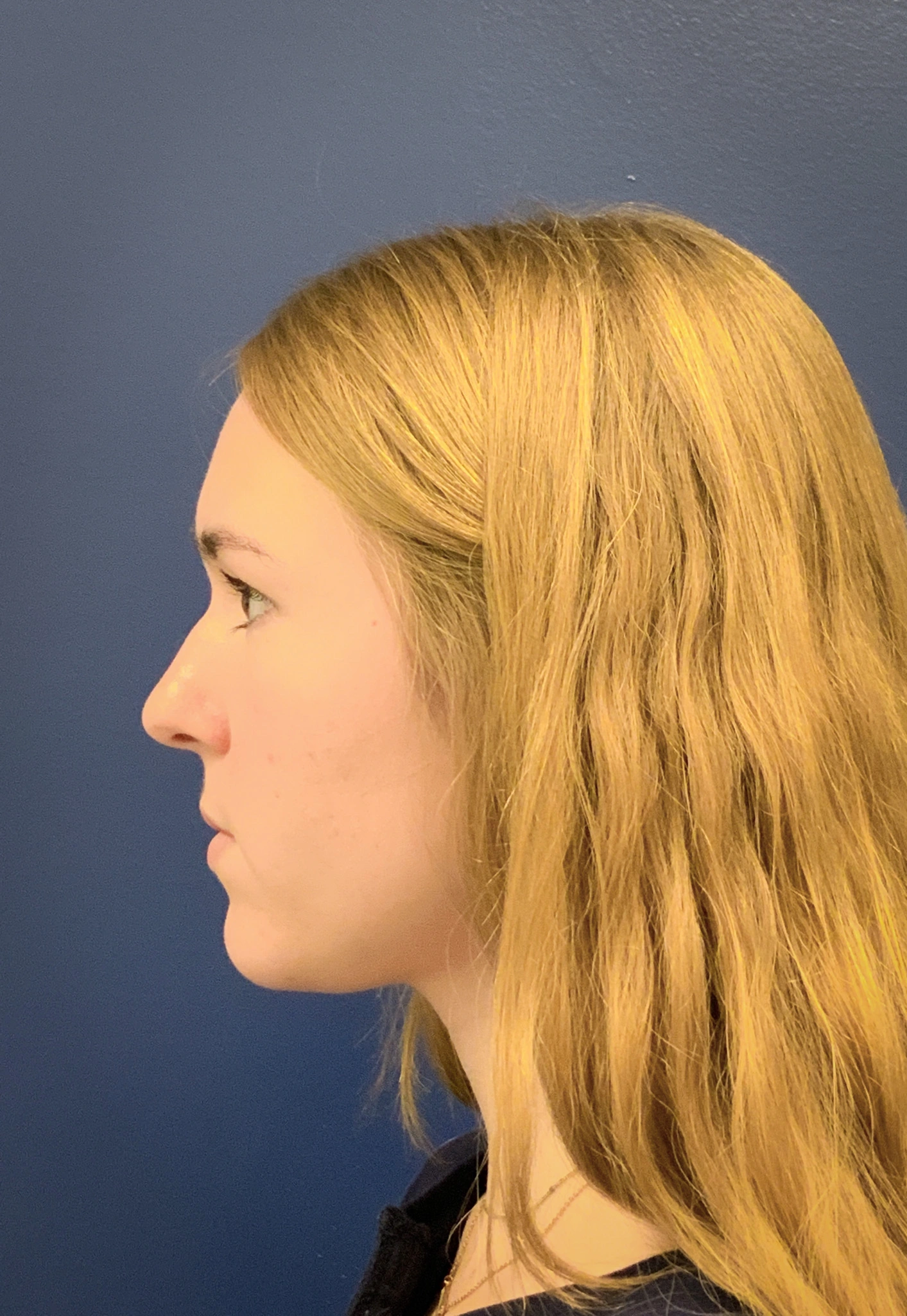 Rhinoplasty-Case--6484 | Before Rhinoplasty 3