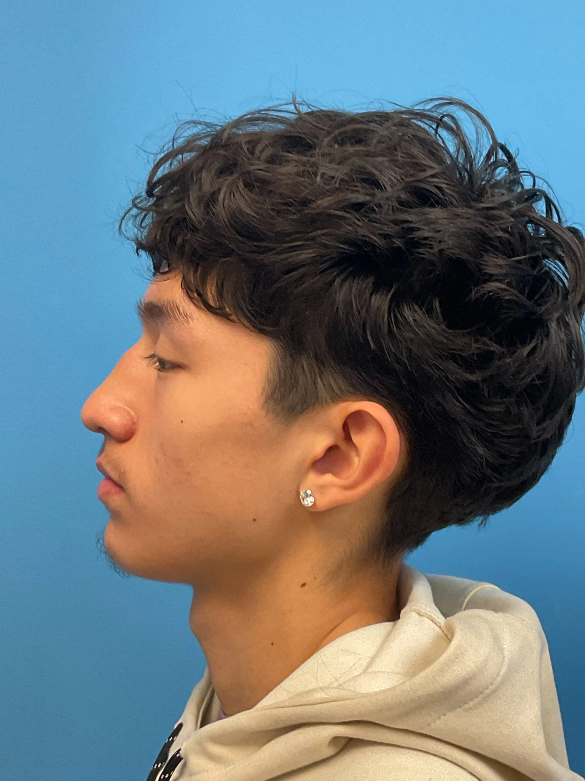 Rhinoplasty-Case--2339 | Before Rhinoplasty 3