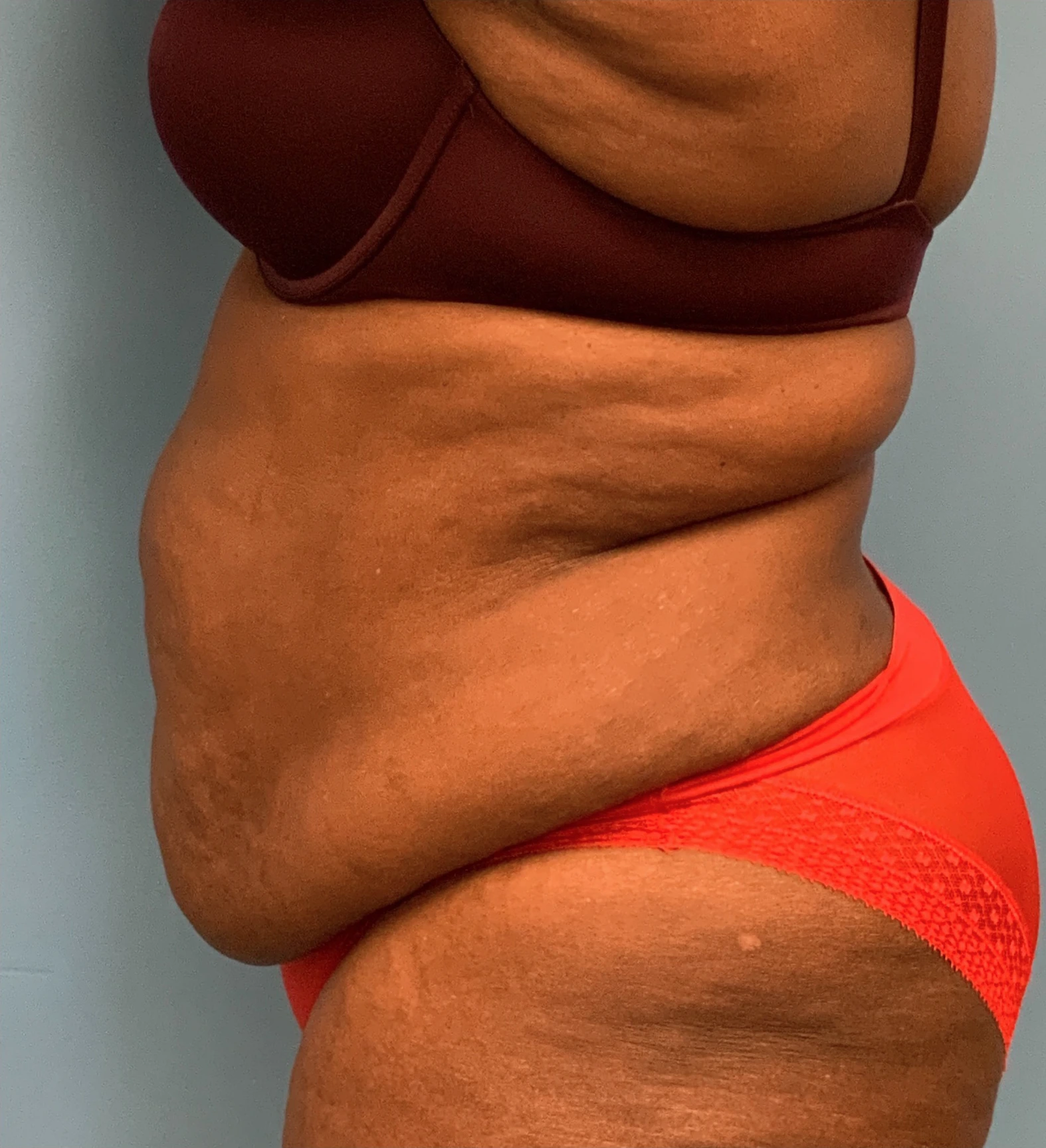 Abdominoplasty-Case--4427 | Before Tummy Tuck 3