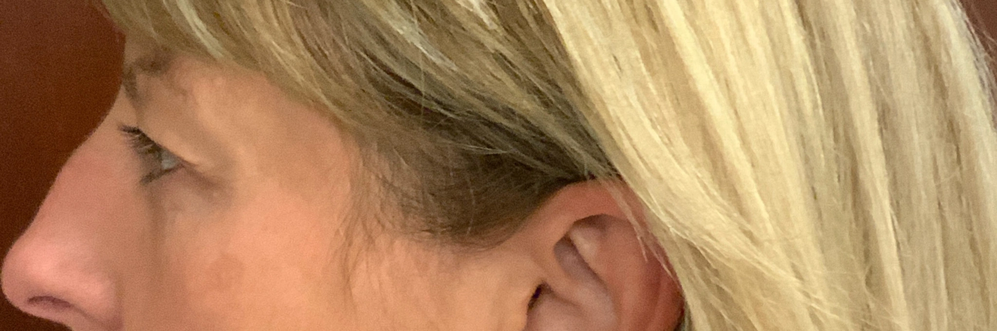 Upper-Blepharoplasty-Case--7202 | After Eyelid Surgery 2