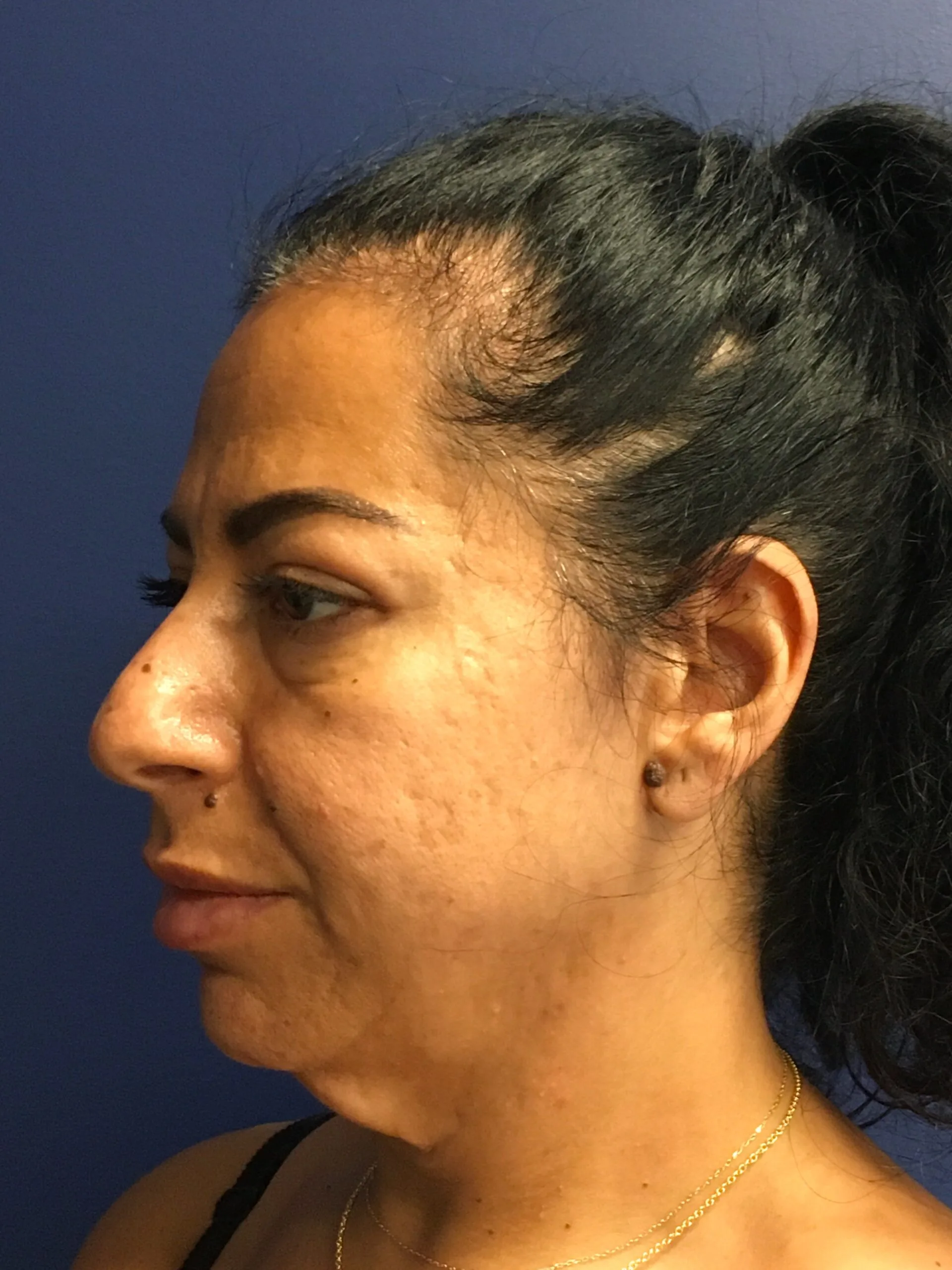 Facelift-Case--8534 | Before Facelift 5