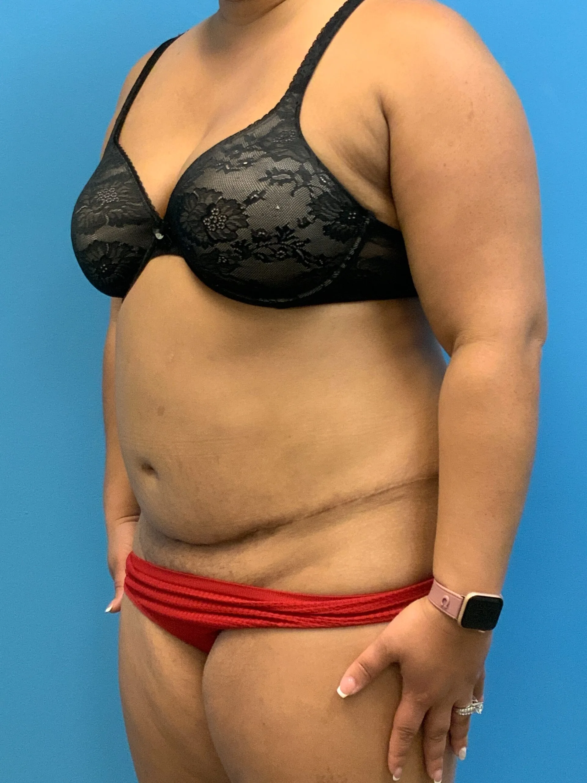 Abdominoplasty-Case--9870 | Before Tummy Tuck 5