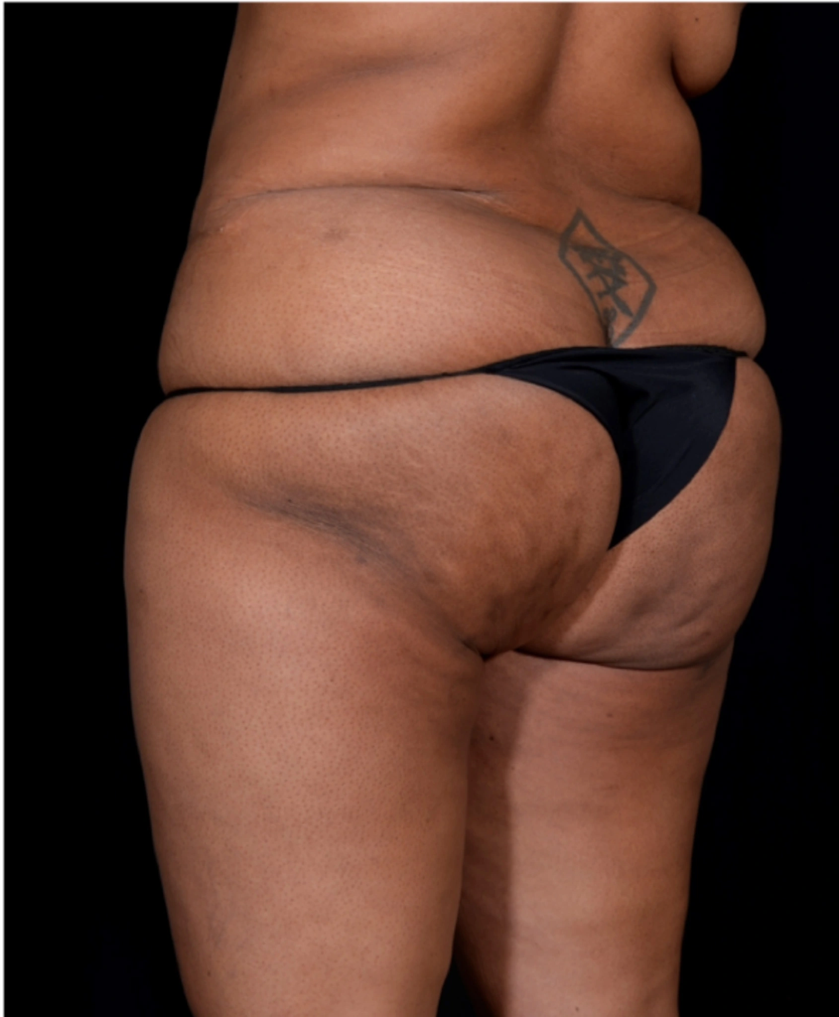 Brazilian-Butt-Lift-Case--7979 | Before Brazilian Butt Lift 3