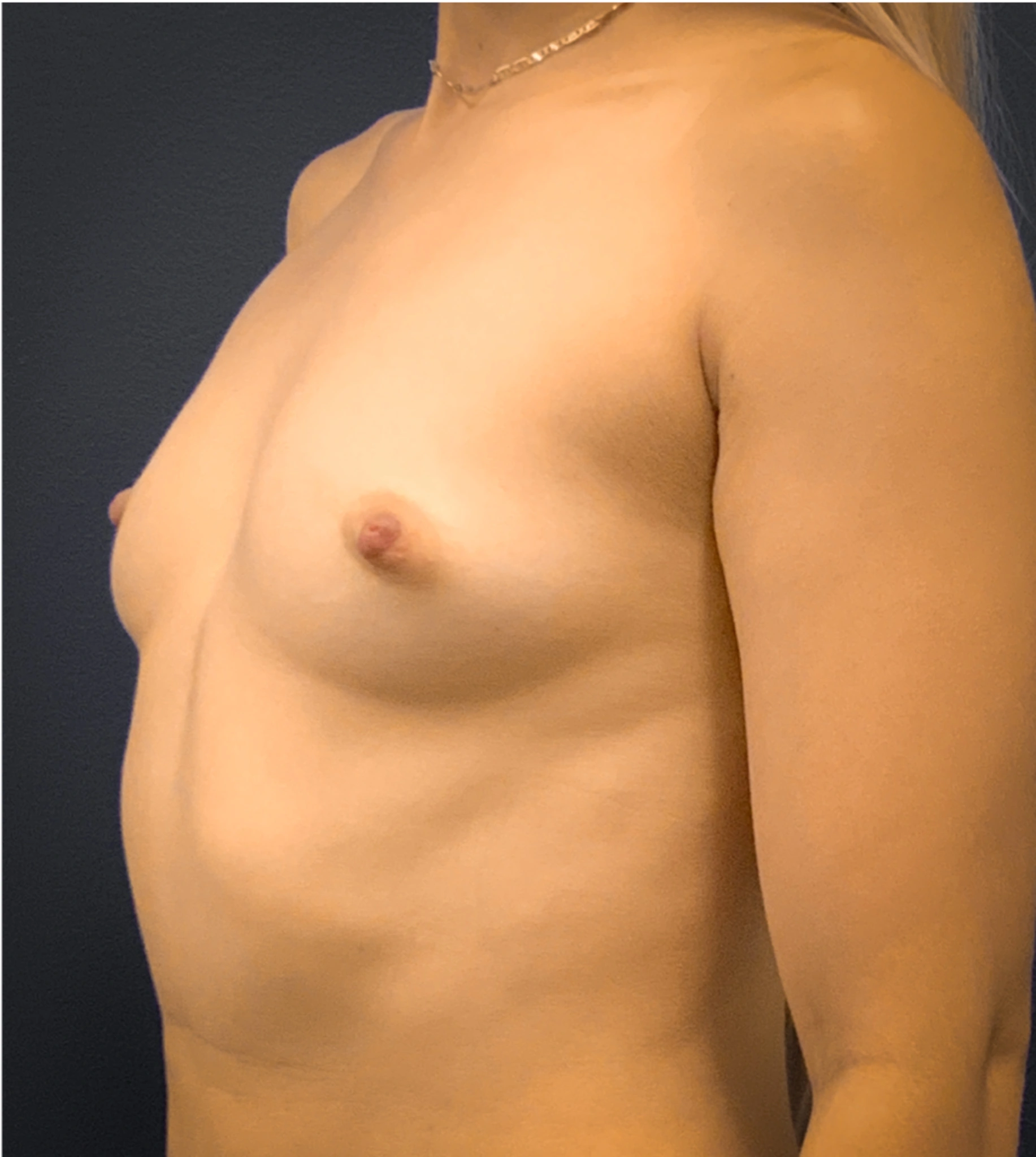 Breast-Augmentation-Case--8208 | Before Breast Augmentation 4