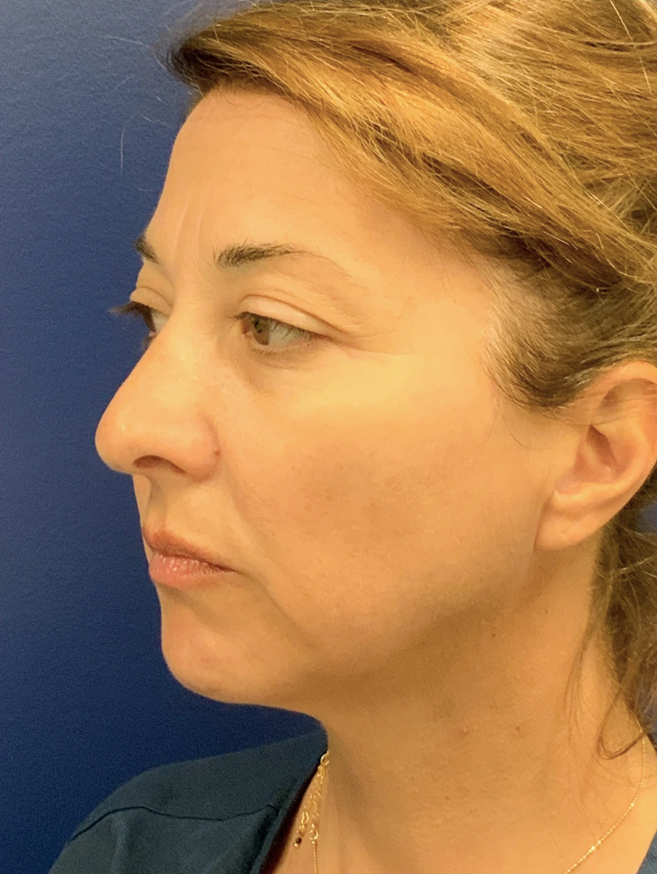 Facelift-Case--8368 | Before Facelift 4