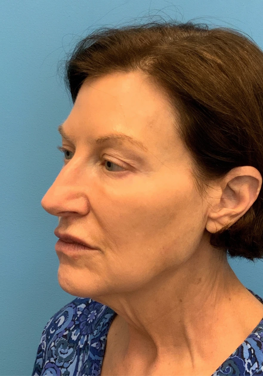 Facelift-Case--6591 | Before Facelift 4