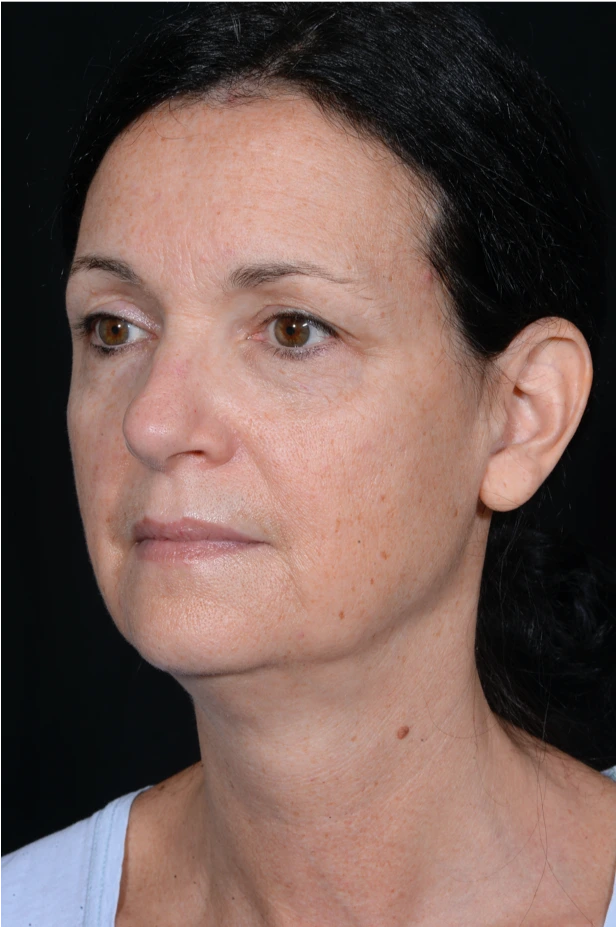 Face-and-Neck-Lift-Case--9403 | Before Facelift 4