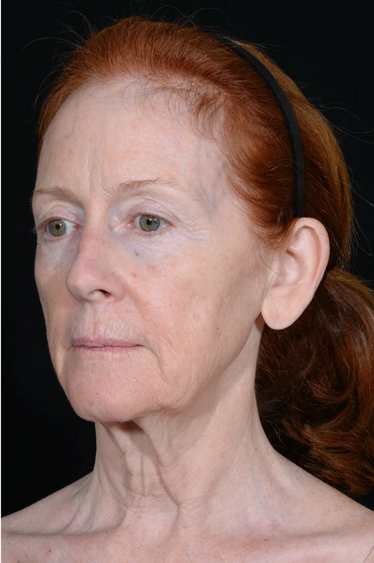 Face-and-Neck-Lift-Case--9302 | Before Facelift 3
