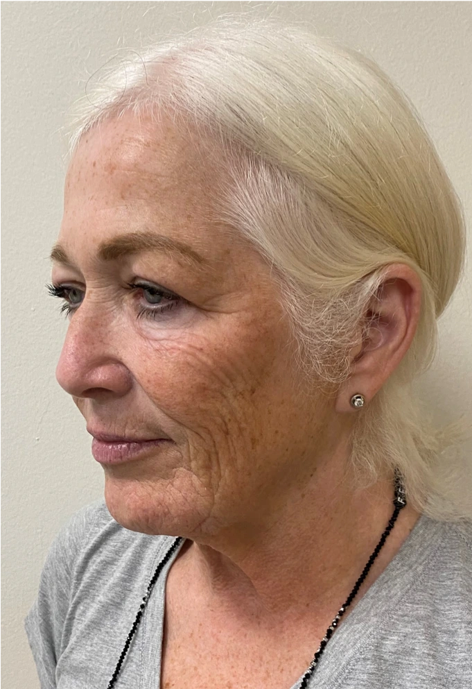 Facelift-Case--8874 | Before Facelift 3