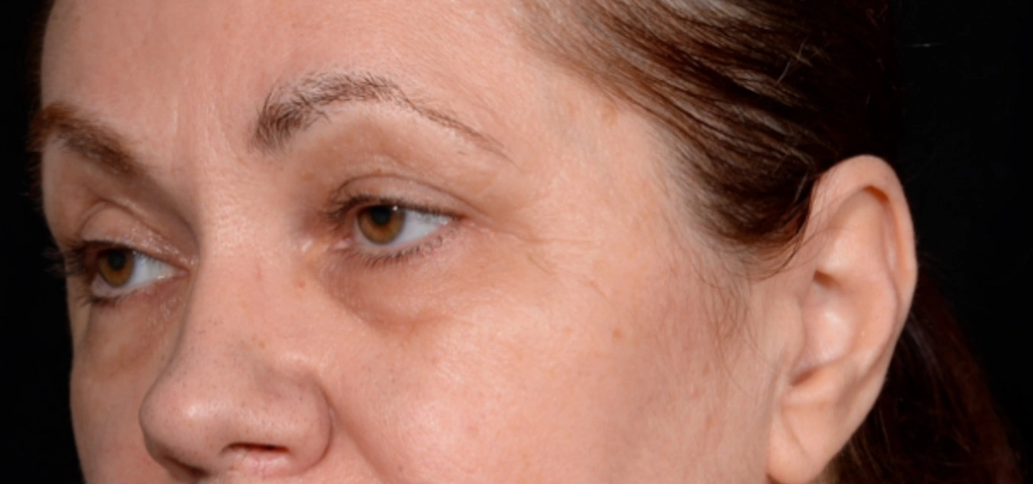 Quad-Blepharoplasty-Case--1851 | Before Eyelid Surgery 4