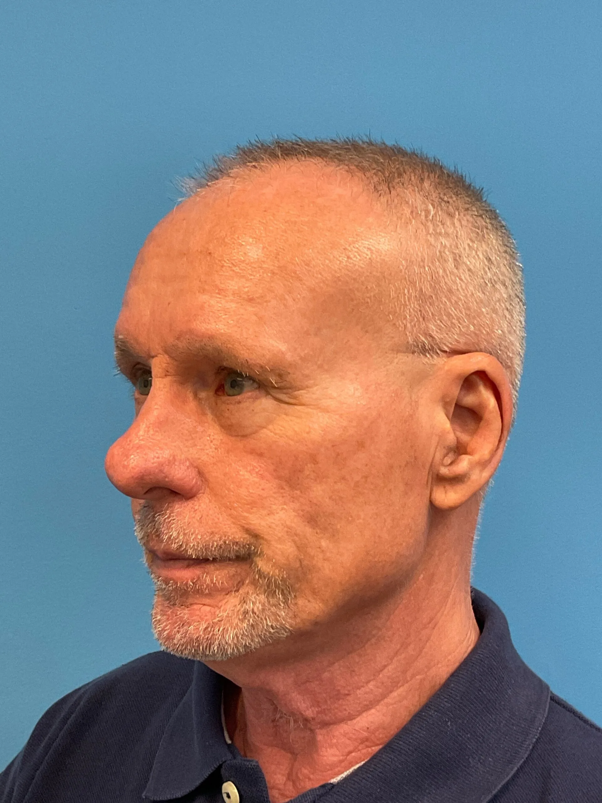 Rhinoplasty-Case--3129 | Before Rhinoplasty 4