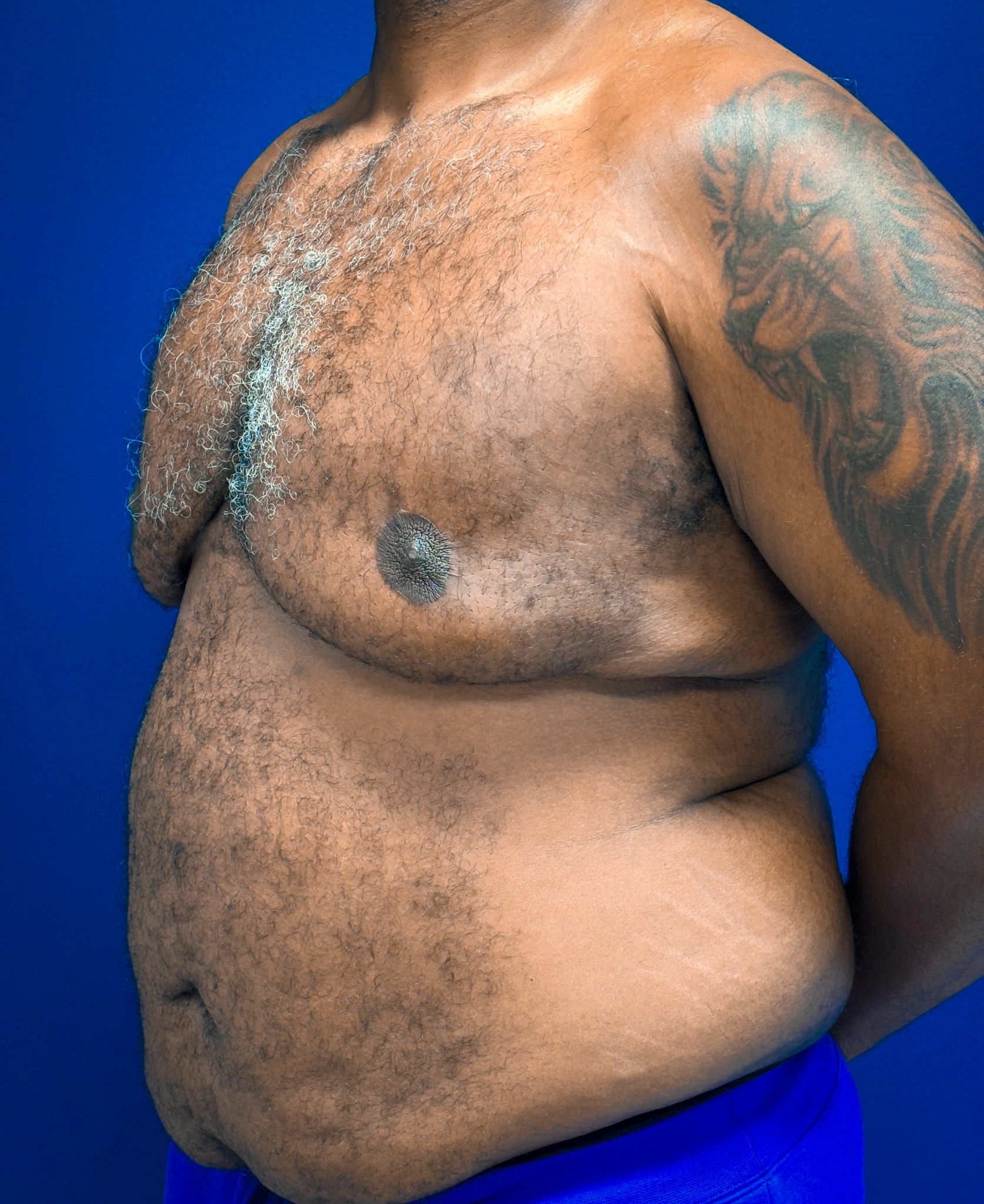 Gynecomastia-Case--4473 | Before Gynecomastia / Male Breast Reduction 5