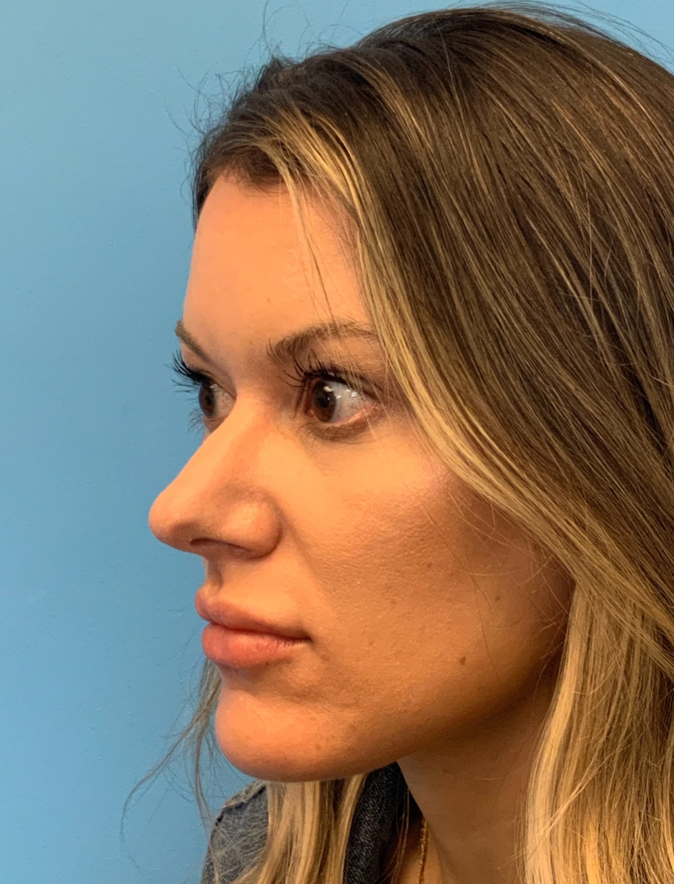 Rhinoplasty-Case--4972 | Before Rhinoplasty 5