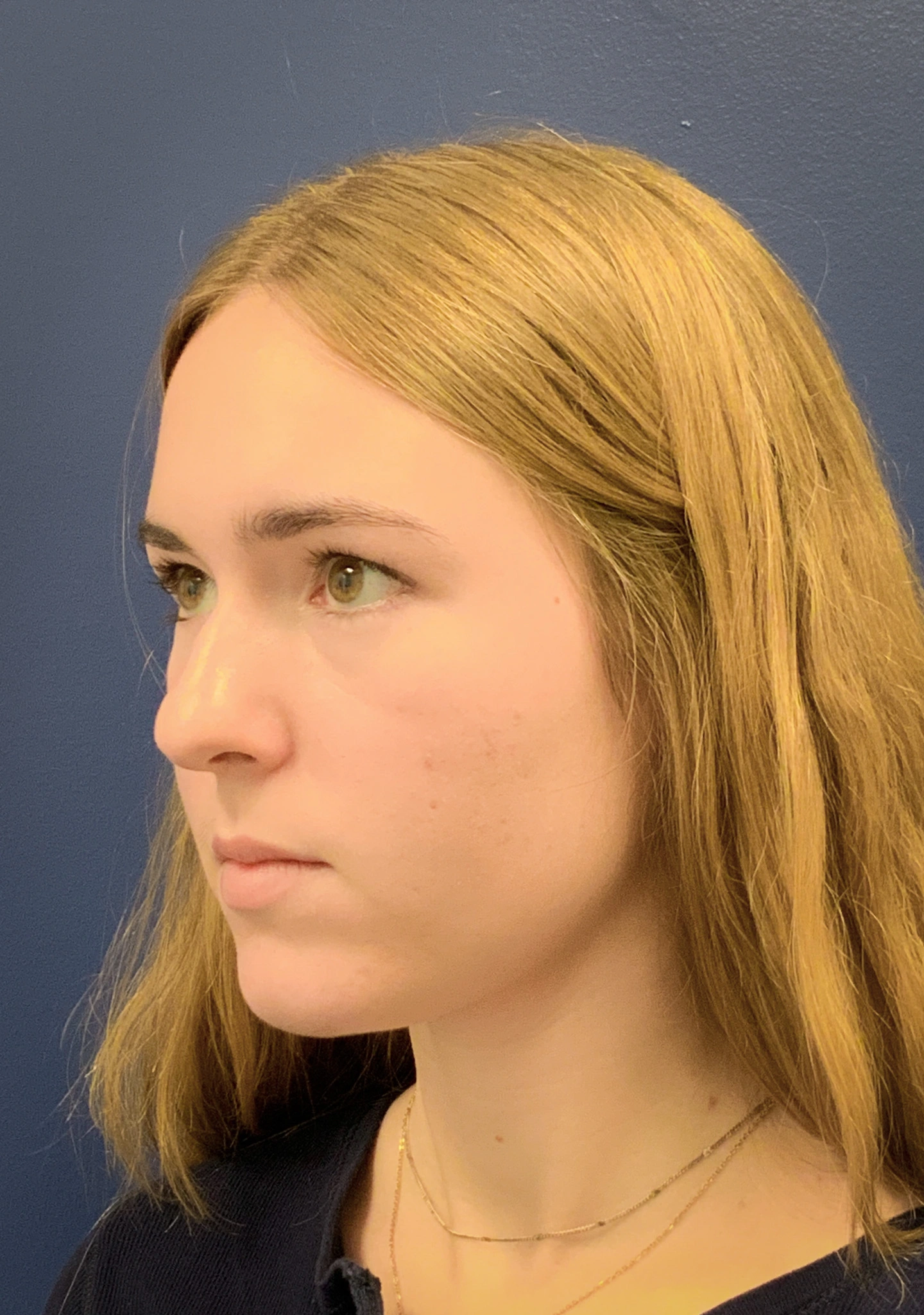 Rhinoplasty-Case--6484 | Before Rhinoplasty 5