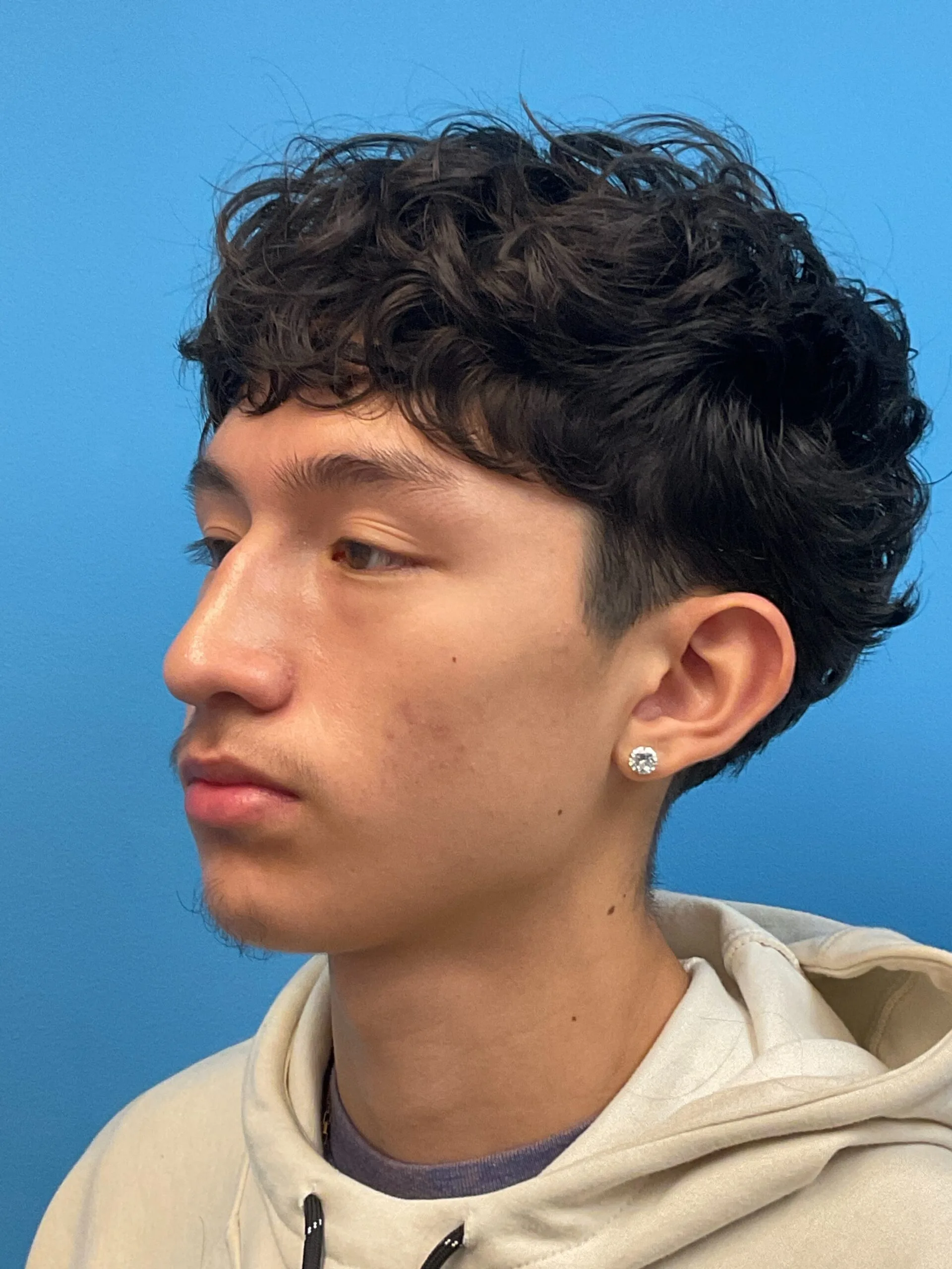 Rhinoplasty-Case--2339 | Before Rhinoplasty 5