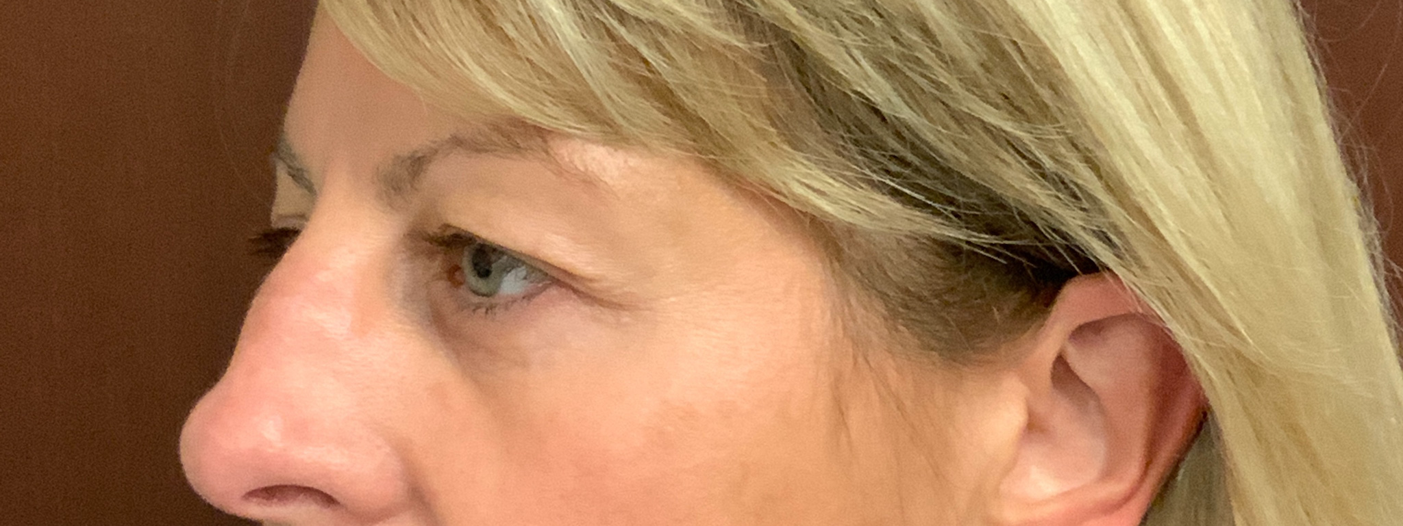 Upper-Blepharoplasty-Case--7202 | After Eyelid Surgery 4