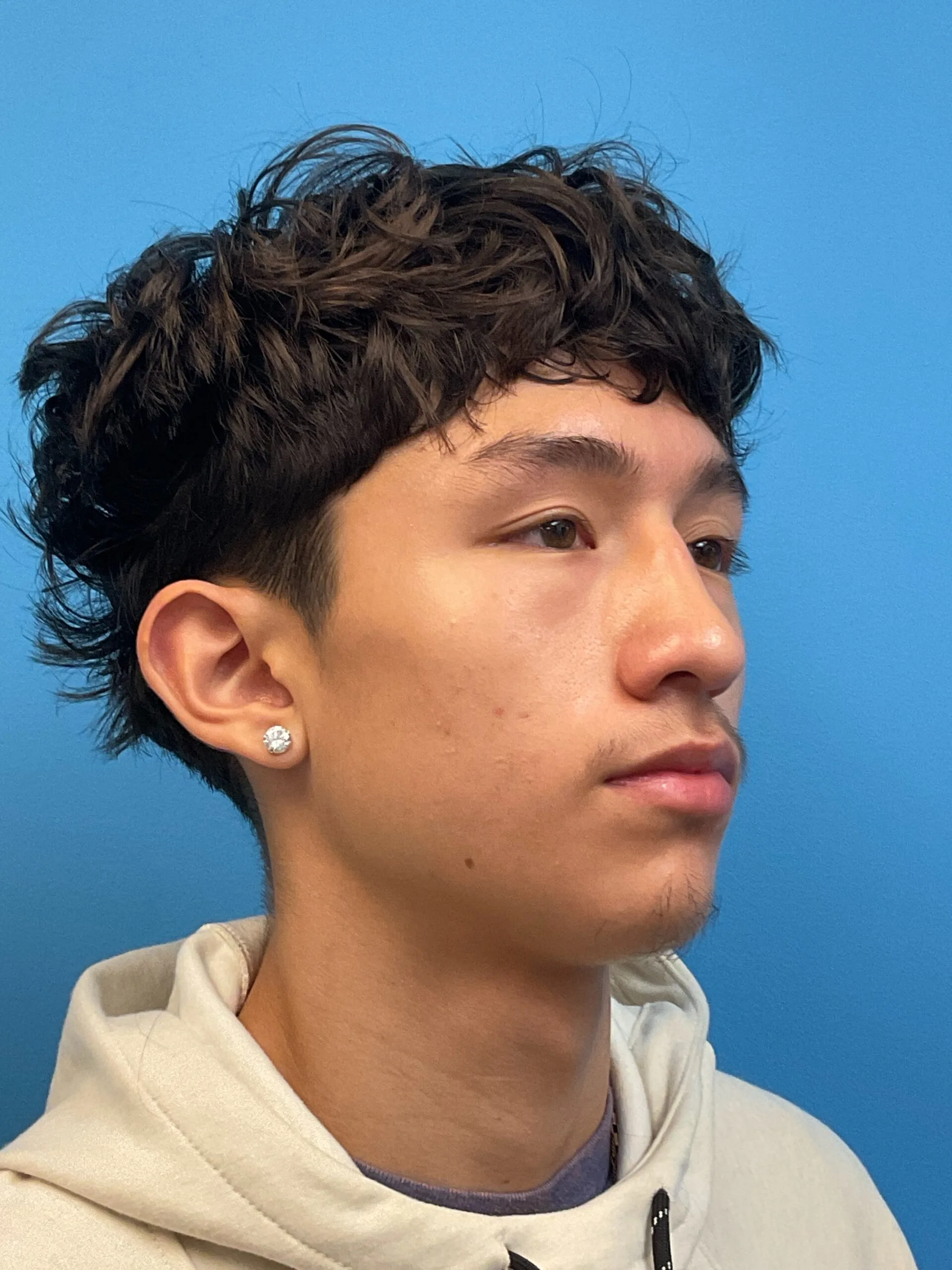 Rhinoplasty-Case--2339 | Before Rhinoplasty 4