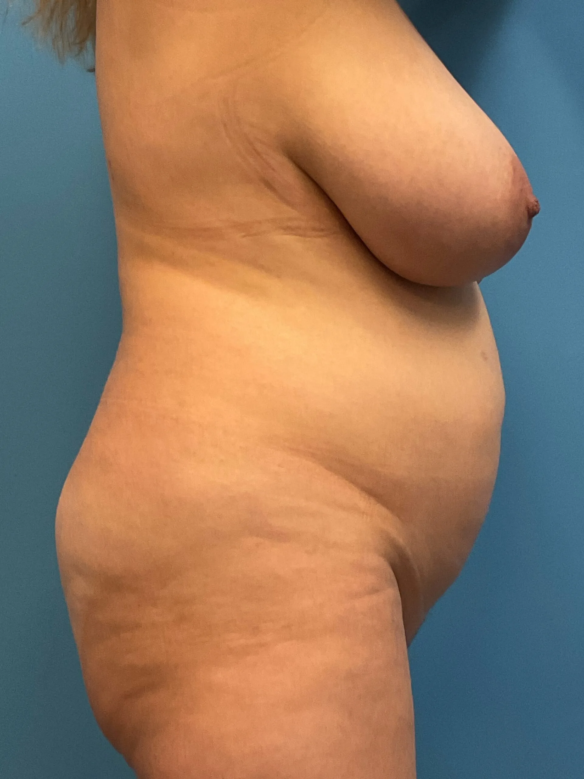 Breast-Reduction-Case--2878 | Before Breast Reduction 3