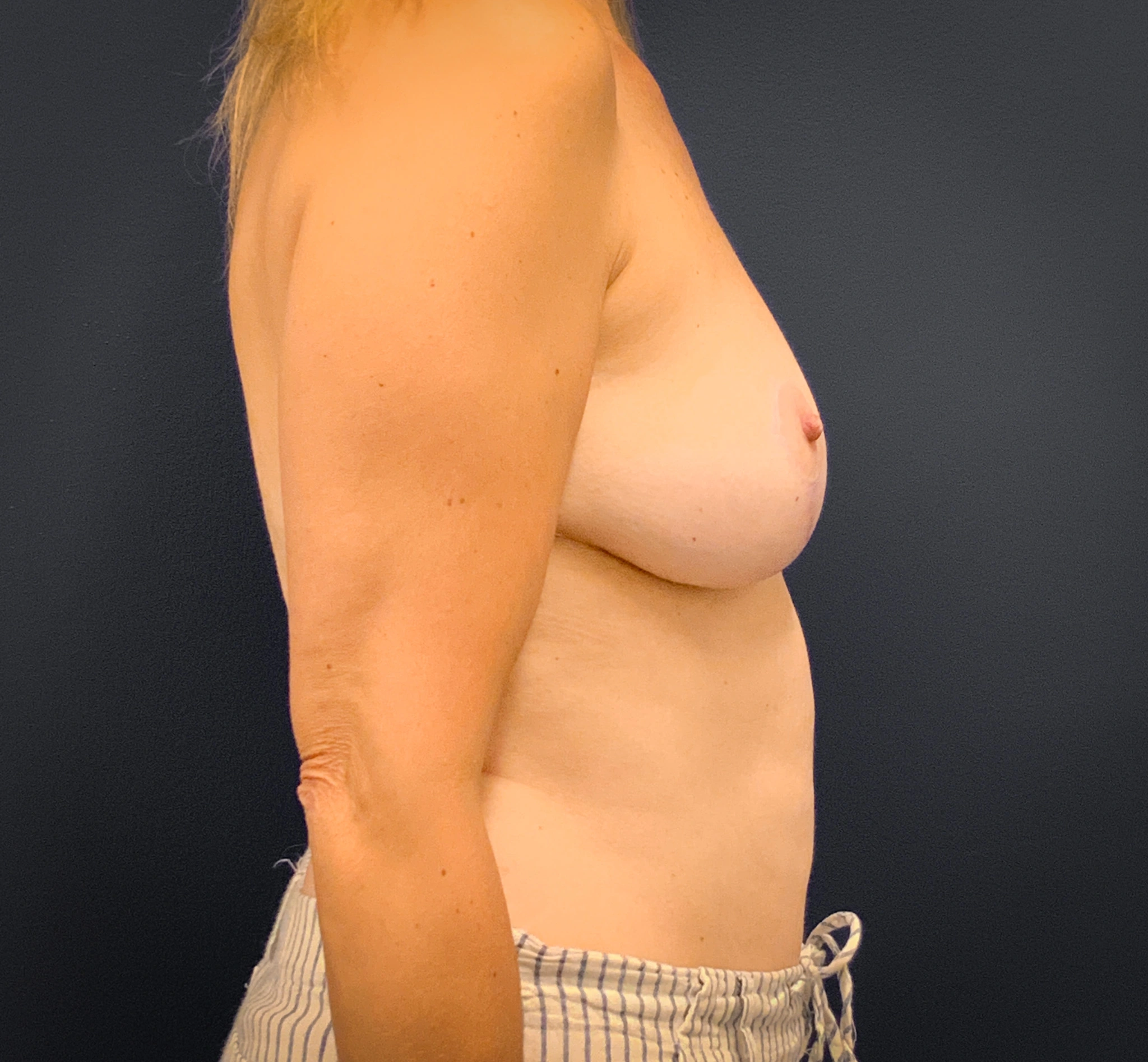 Breast-Augmentation-Case--3336 | Before Breast Augmentation 3