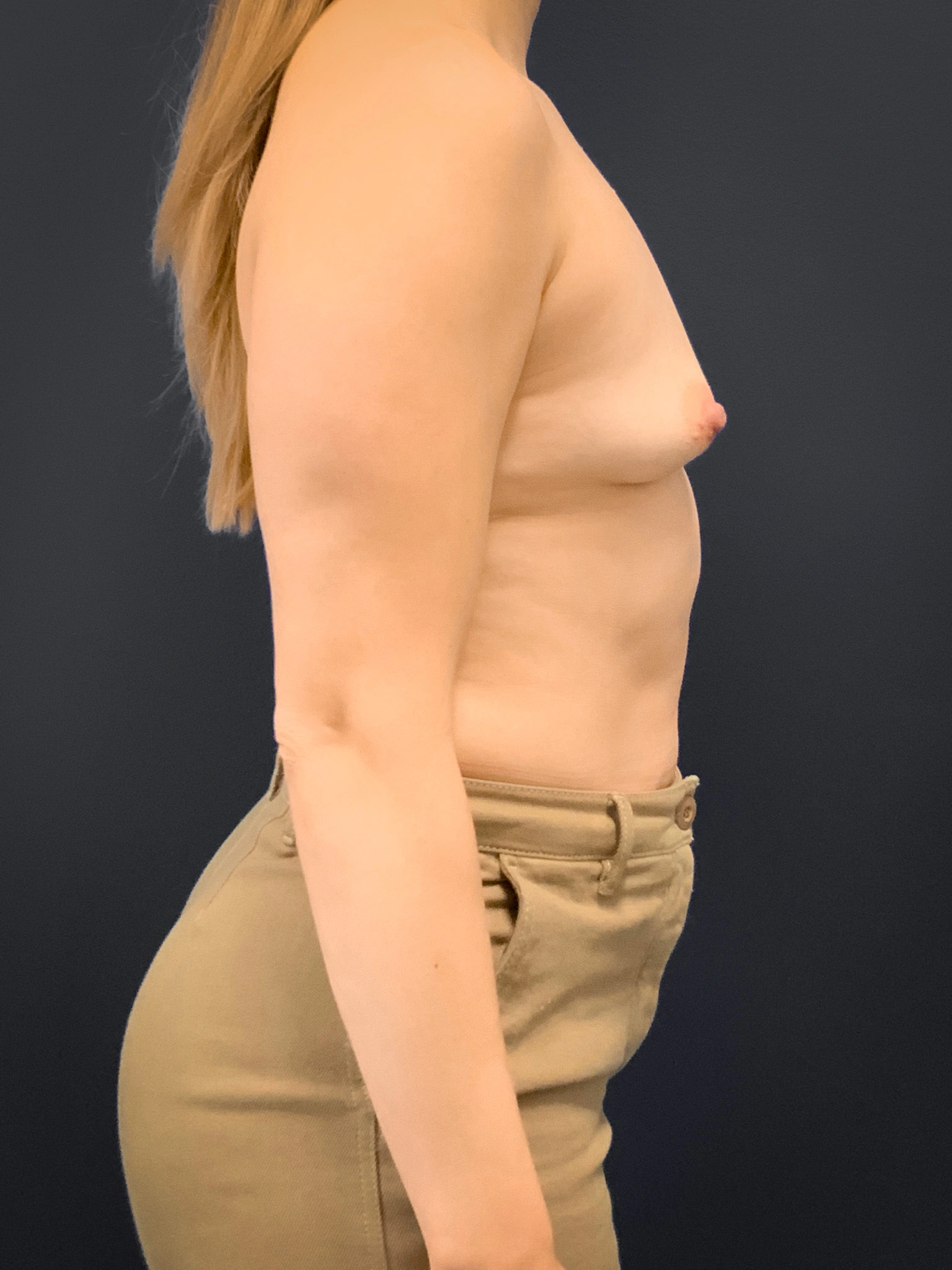 Breast-Augmentation-Case--2225 | Before Breast Augmentation 2