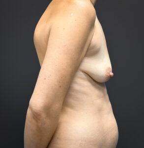 Breast-Augmentation-Case--7139 | Before Breast Augmentation 2