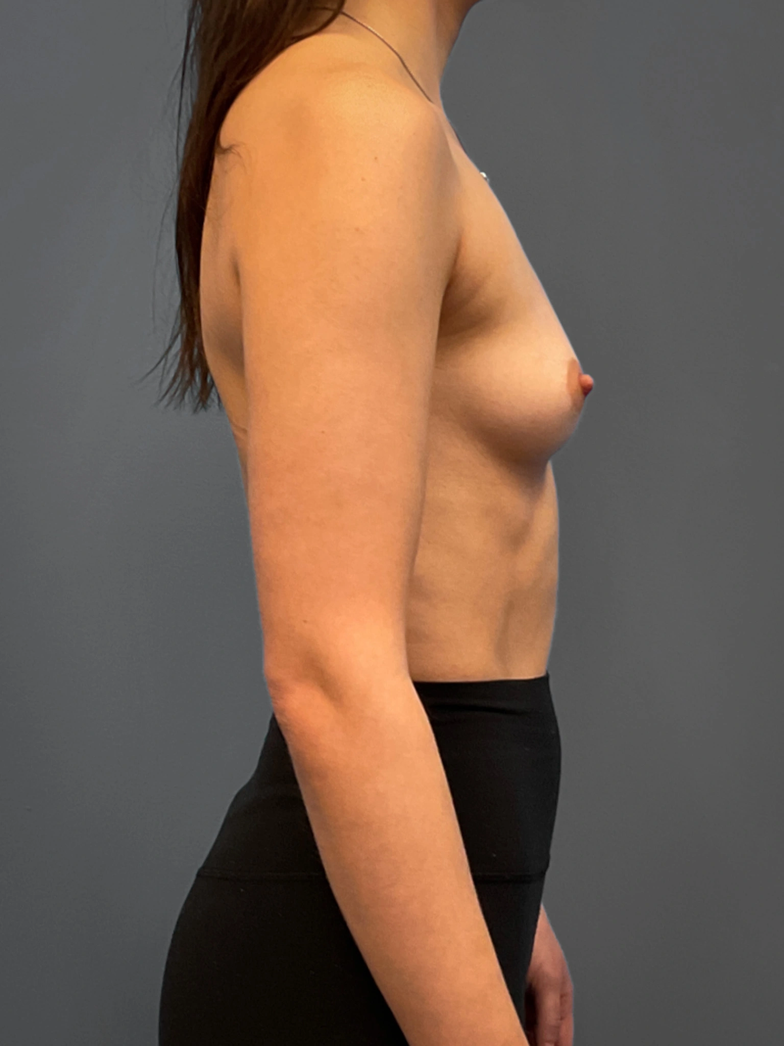 Breast-Augmentation-Case--6687 | Before Breast Augmentation 3