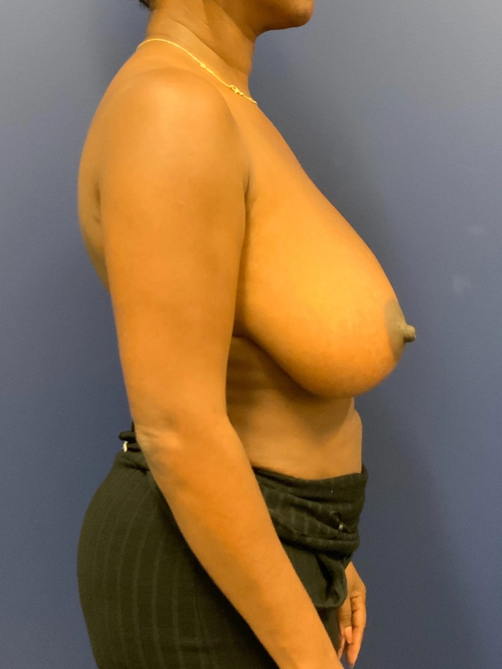 Breast-Reduction-Case--9689 | Before Breast Reduction 2