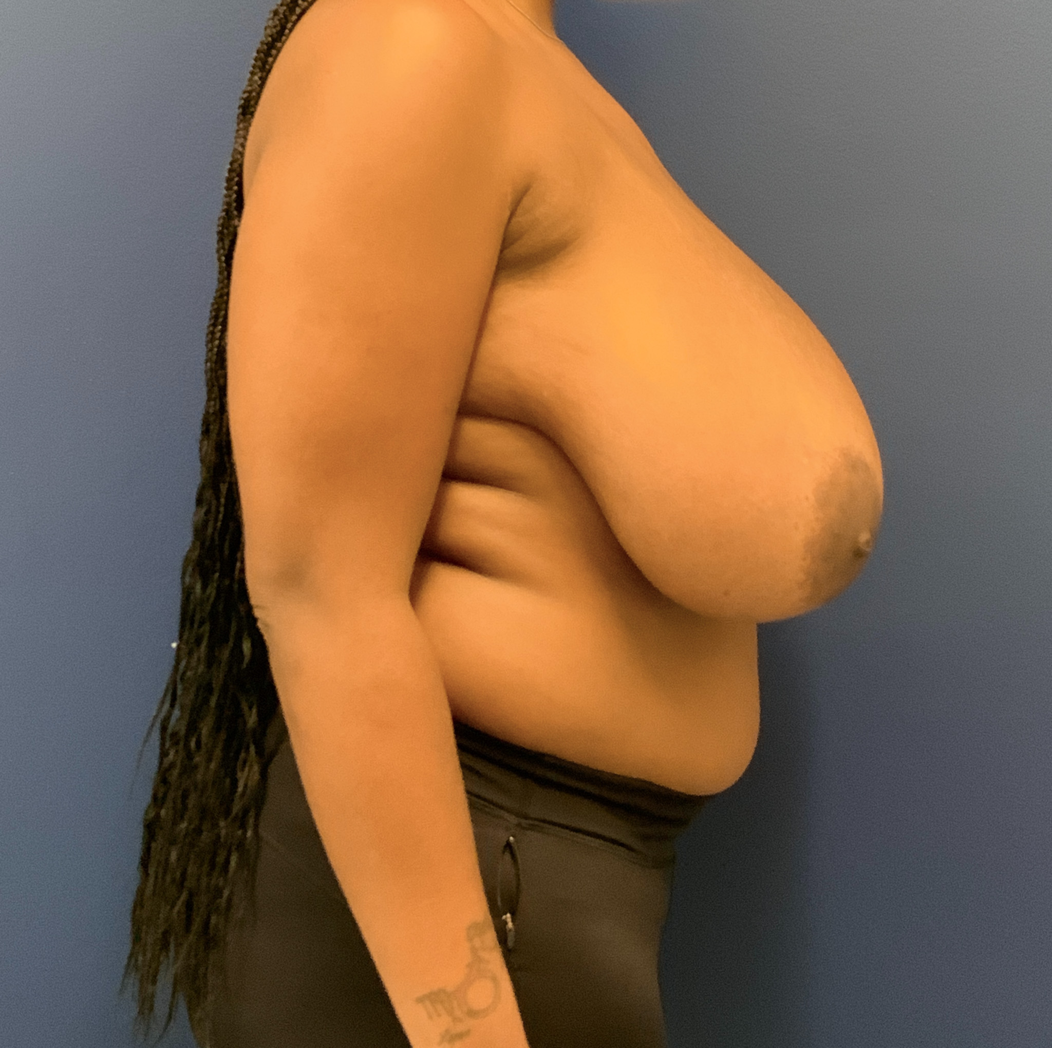 Breast-Reduction-Case--9235 | Before Breast Reduction 3