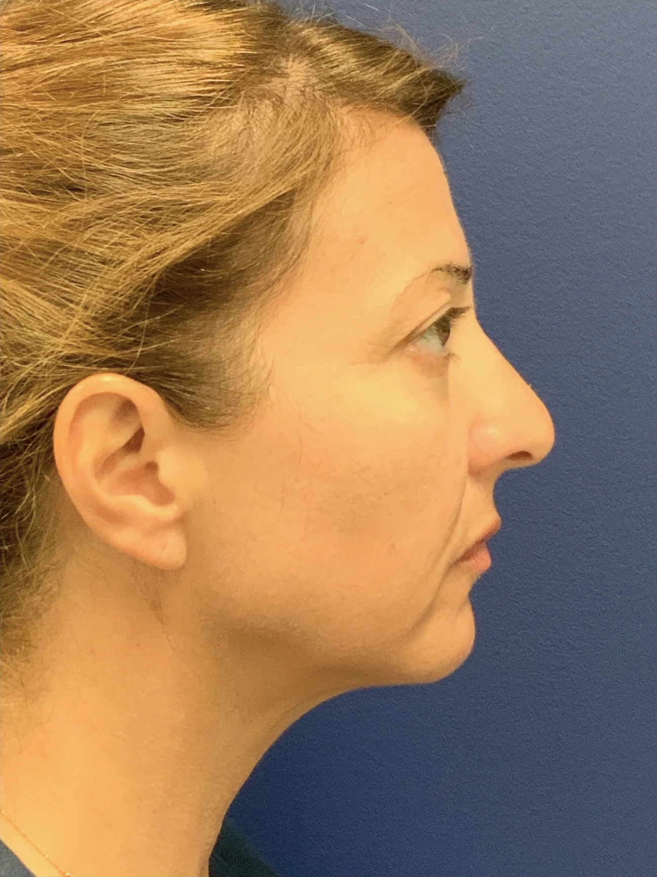 Facelift-Case--8368 | Before Facelift 3