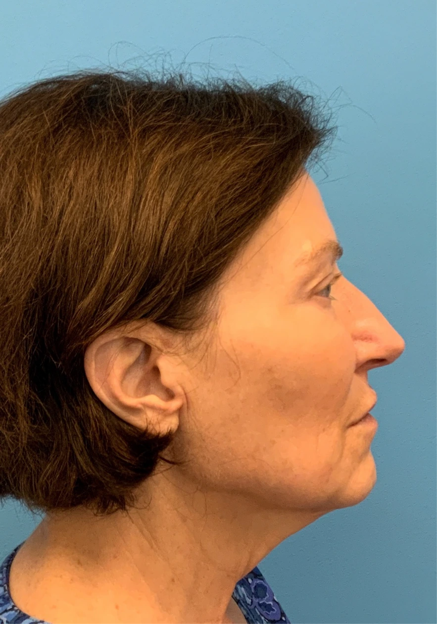 Facelift-Case--6591 | Before Facelift 3