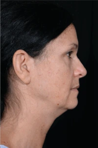 Face-and-Neck-Lift-Case--9403 | Before Neck Lift 2