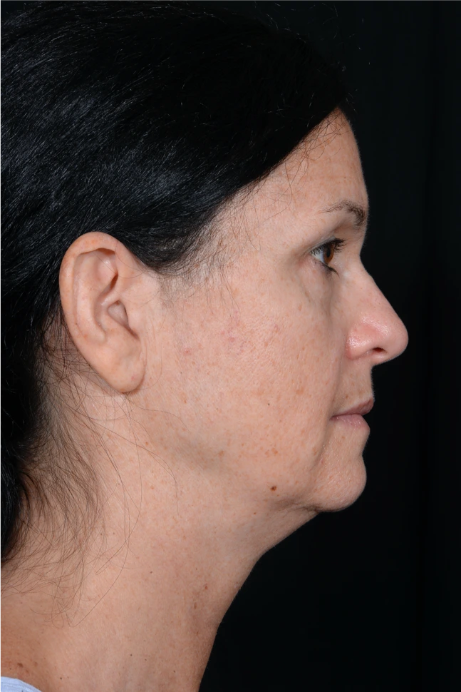 Face-and-Neck-Lift-Case--9403 | Before Facelift 2