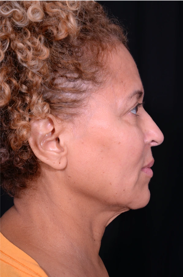 Face-and-Neck-Lift-Case--3772 | Before Facelift 3
