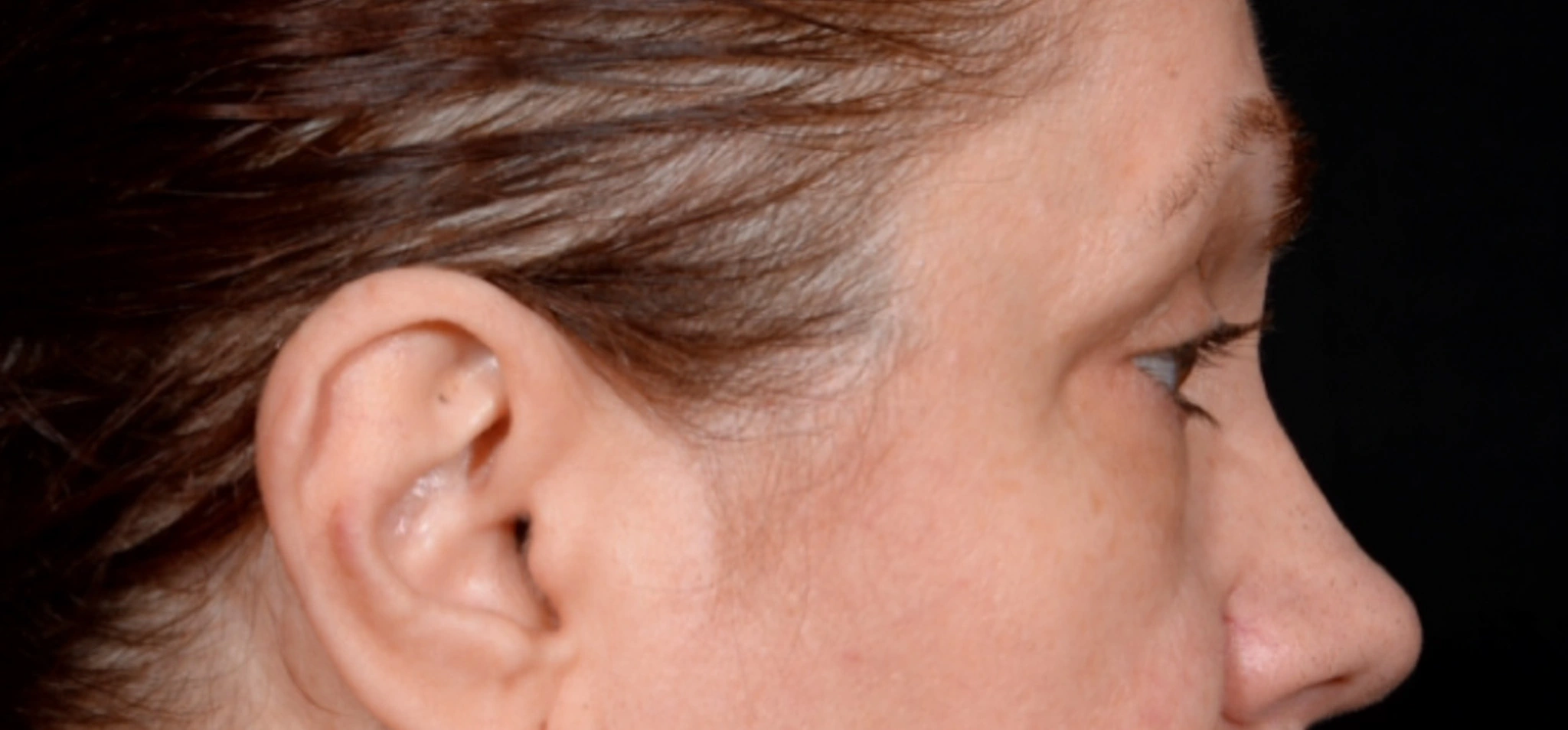 Quad-Blepharoplasty-Case--1851 | Before Eyelid Surgery 1