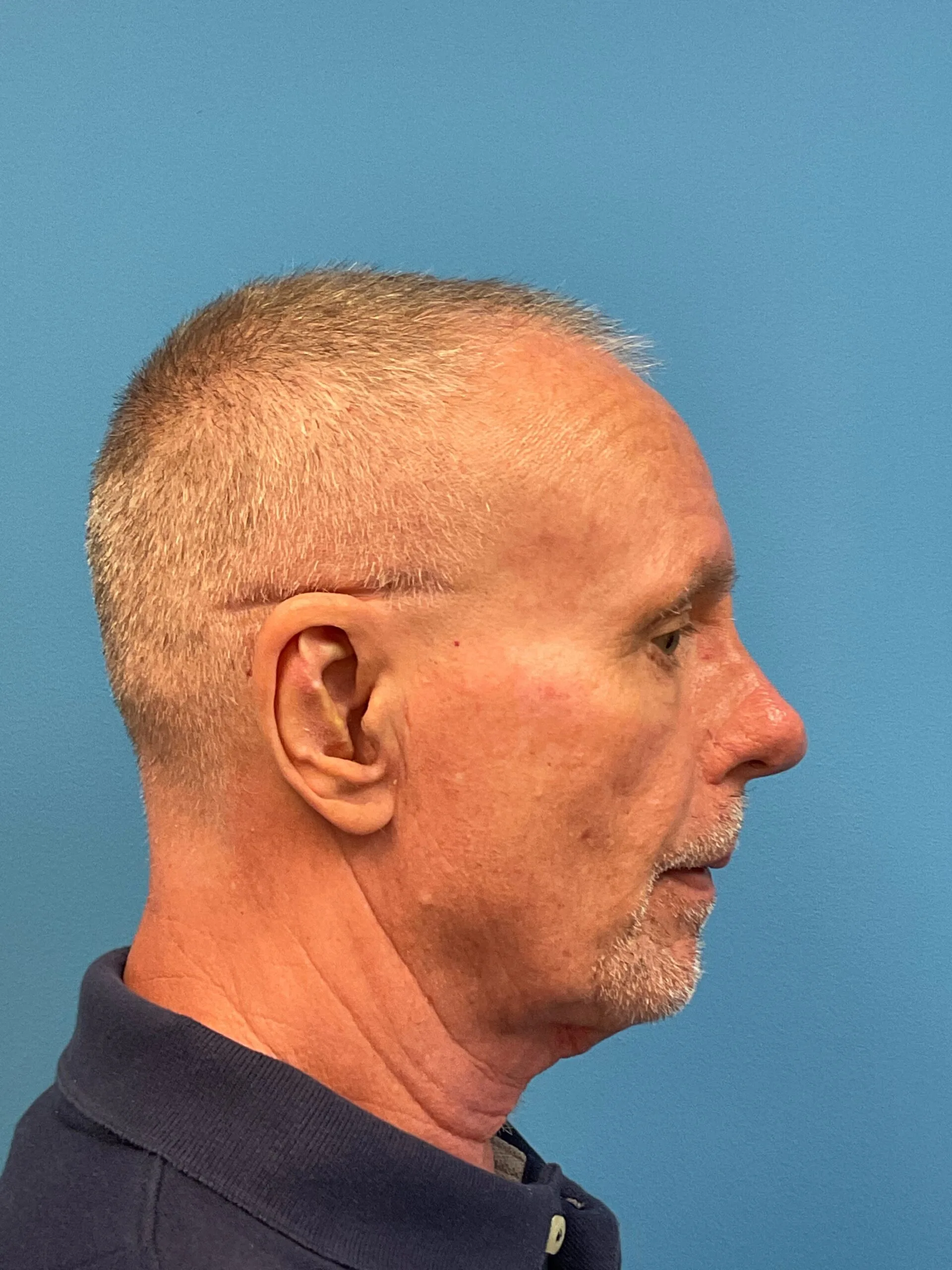 Rhinoplasty-Case--3129 | Before Rhinoplasty 3