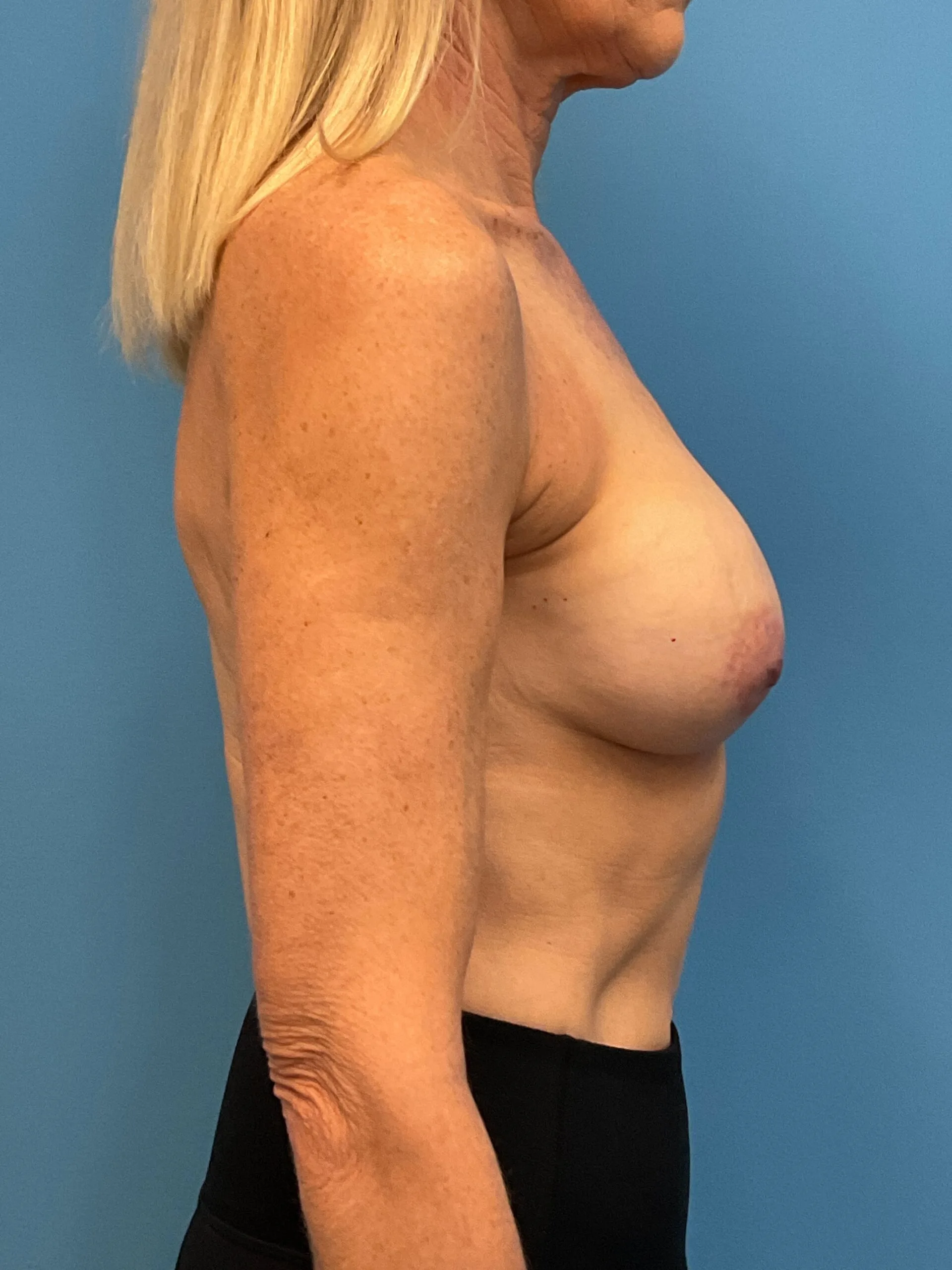 Revision-Breast-Augmentation-Case--9027 | Before Revision Augmentation 2