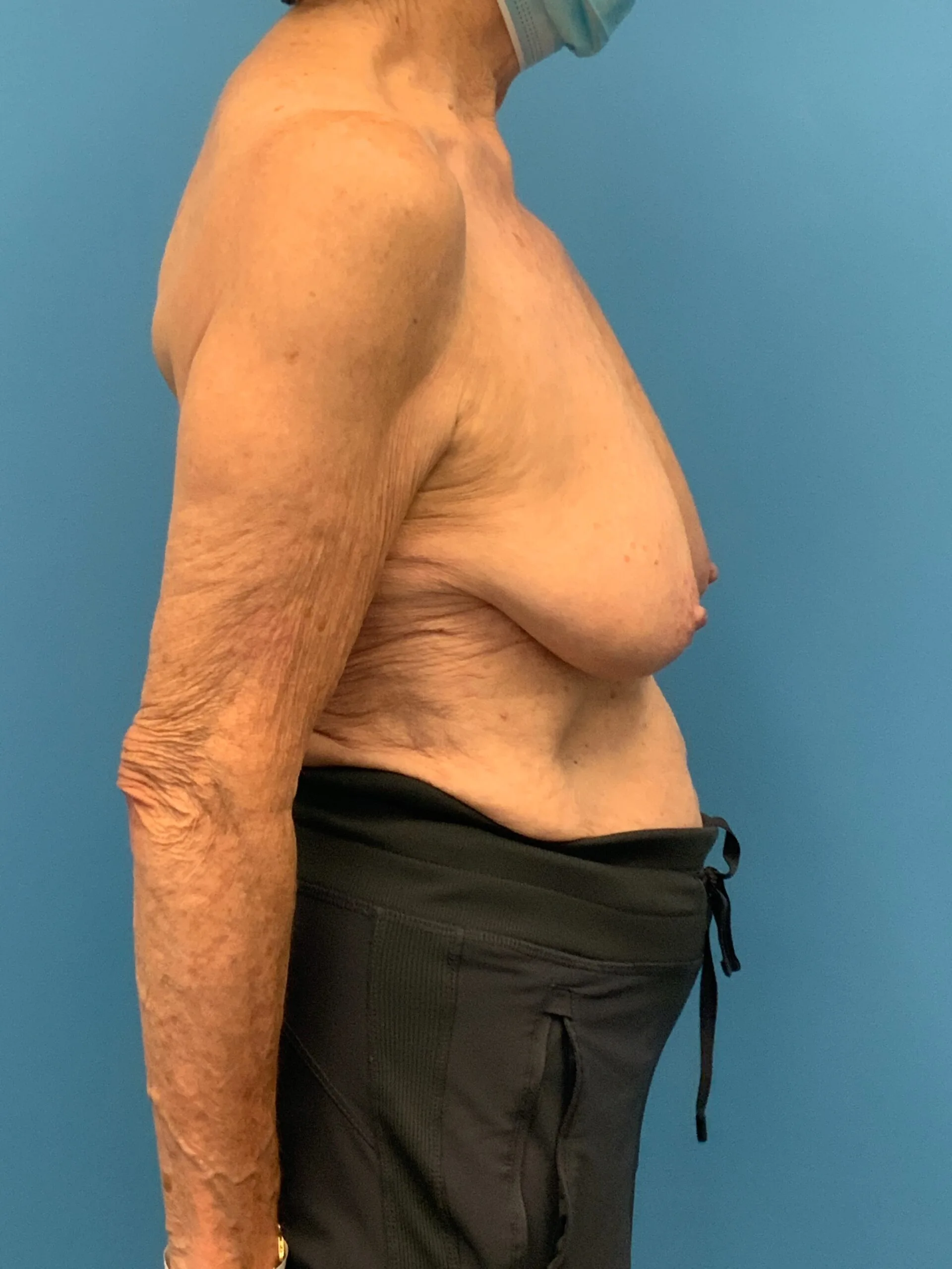 Augmentation-Mastopexy-Case--4504 | Before Breast Augmentation With Lift 3