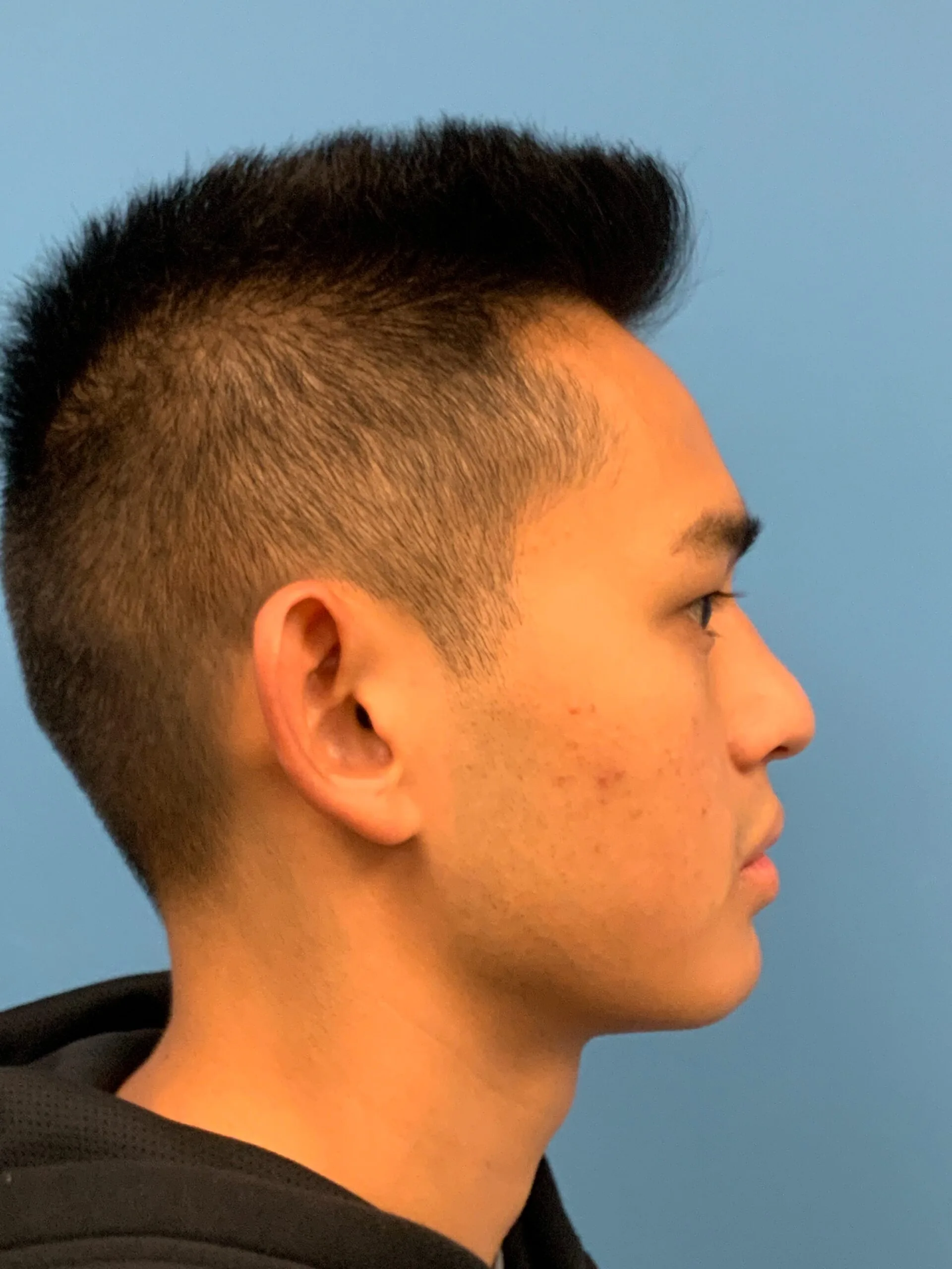 Otoplasty-Case--2681 | Before Otoplasty 3