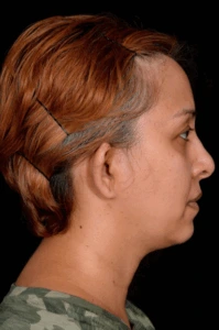 Otoplasty-Case--4655 | Before Otoplasty 2