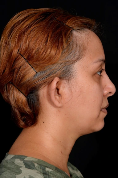 Otoplasty-Case--4655 | Before Otoplasty 2