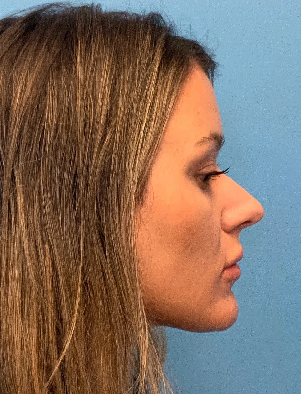 Rhinoplasty-Case--4972 | Before Rhinoplasty 3