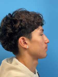 Rhinoplasty-Case--2339 | Before Rhinoplasty 2