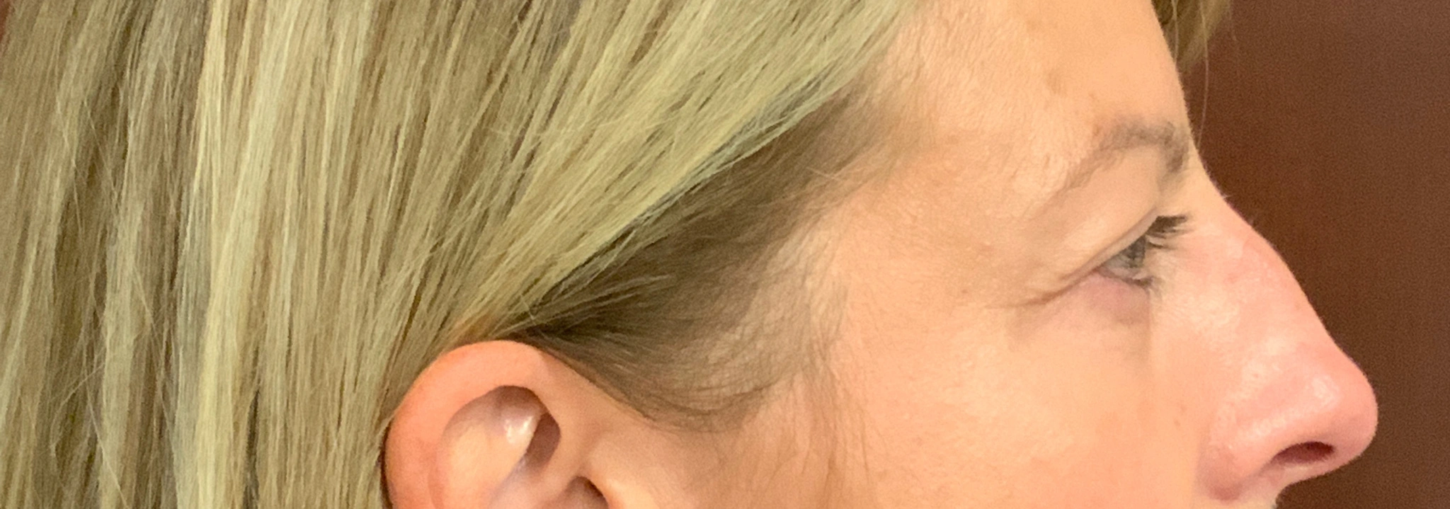 Upper-Blepharoplasty-Case--7202 | After Eyelid Surgery 3