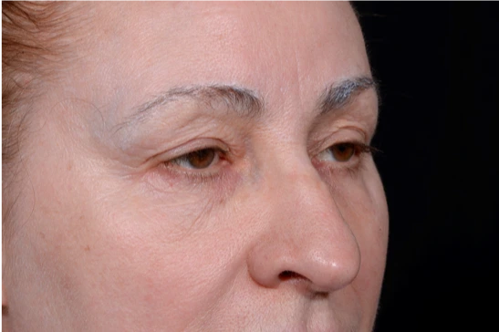 Blepharoplasty-Case--9685 | Before Eyelid Surgery 3