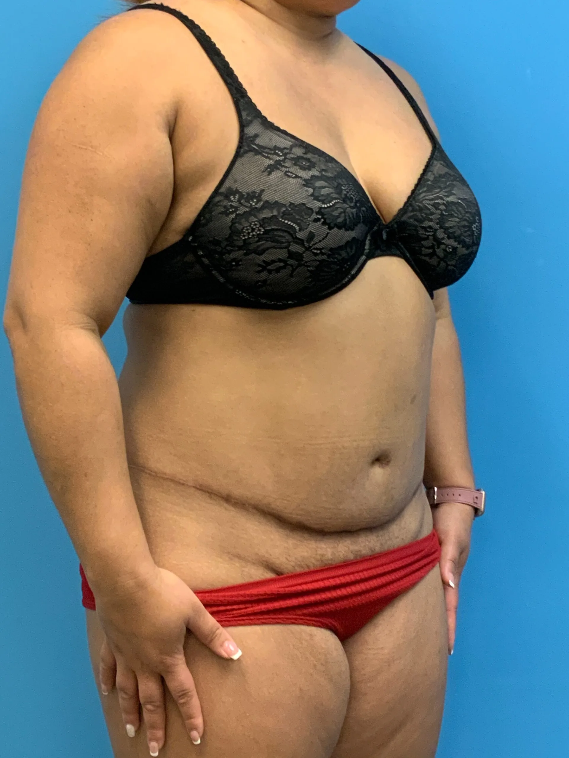 Abdominoplasty-Case--9870 | Before Tummy Tuck 4